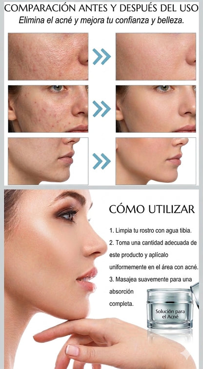 Crema tratamiento acné mascarilla facial